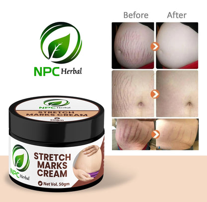 Stretch Marks Cream